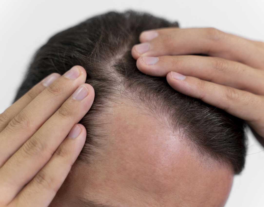 5 Essential tips to Prevent hair loss tips- Phootra